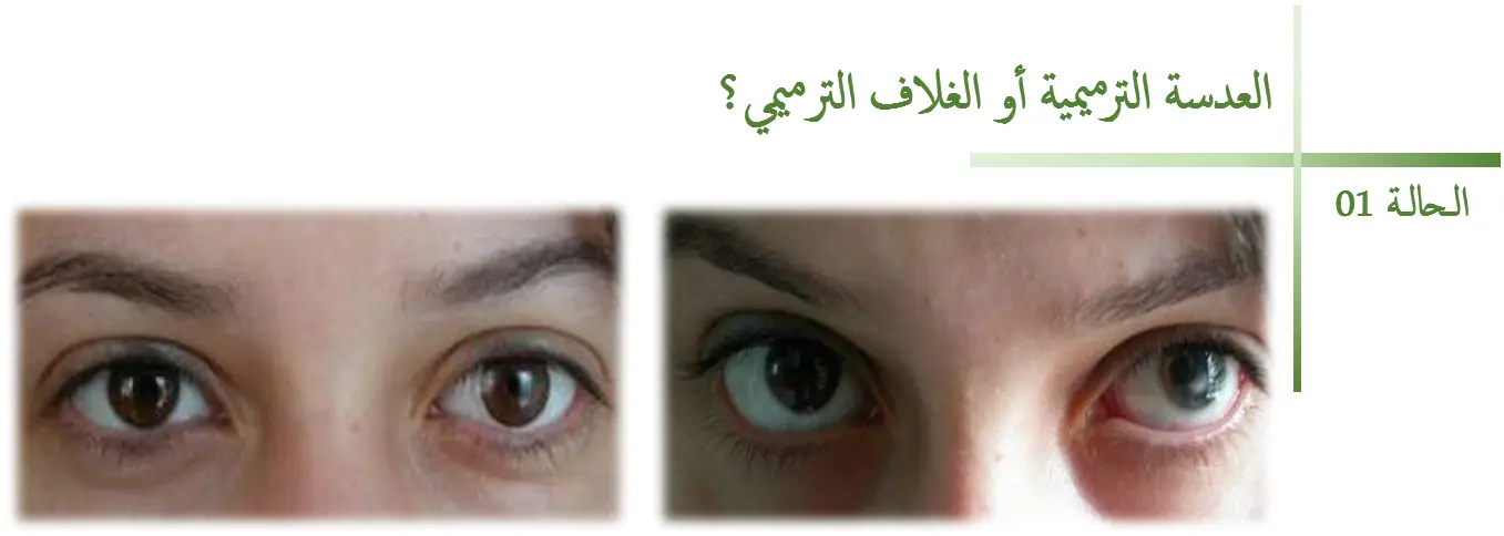 الحالة 1 - تركيب العدسة الترميمية