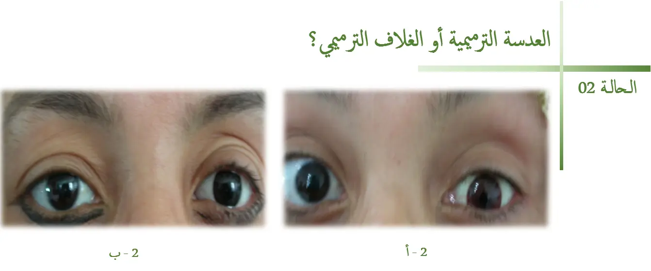 الحالة 2 - تركيب الغلاف الترميمي