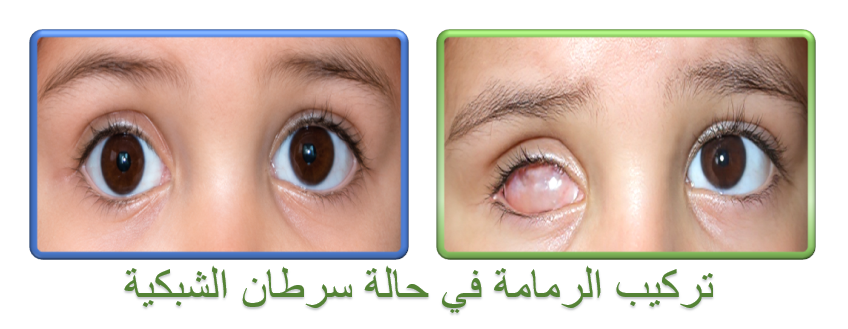 تركيب رمامة في حالة سرطان الشبكية