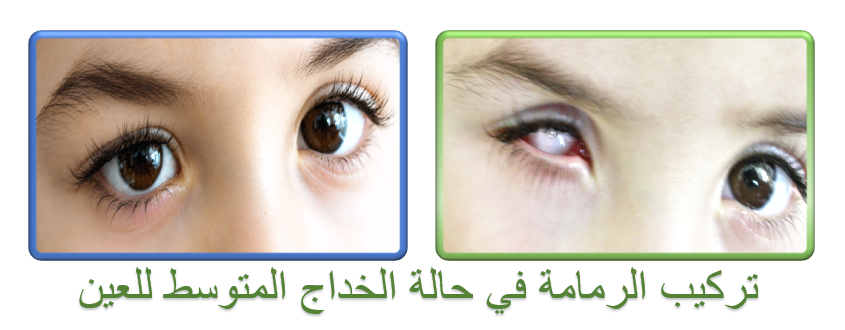 تركيب رمامة في حالة الخداج المتوسط للعين