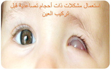 خطوات تركيب الرمامة للأطفال